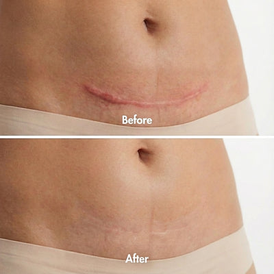 Derva™ Scar Solutions Silicone Stick