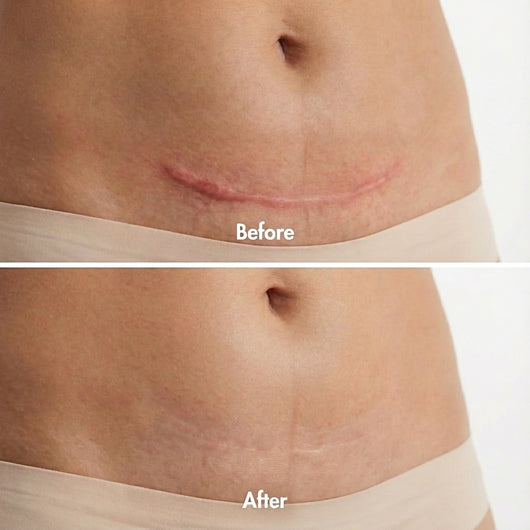 Derva™ Scar Solutions Silicone Stick