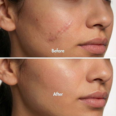 Derva™ Scar Solutions Silicone Stick